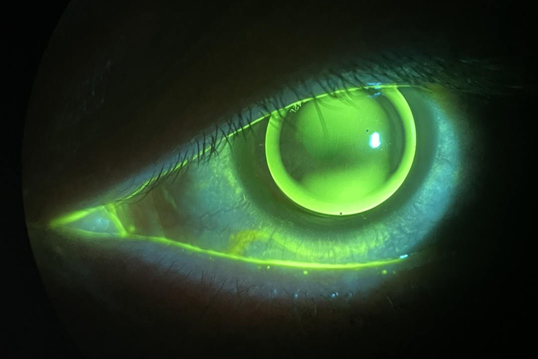 A trial fitting of RGP lenses for keratoconus